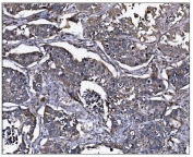 IHC staining of FFPE human lung cancer tissue with ERAP2 antibody. HIER: boil tissue sections in pH8 EDTA for 20 min and allow to cool before testing.