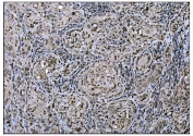 IHC staining of FFPE human gallbladder adenocarcinoma tissue with FosB antibody. HIER: boil tissue sections in pH8 EDTA for 20 min and allow to cool before testing.