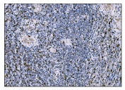 IHC staining of FFPE human gallbladder adenocarcinoma tissue with FosB antibody. HIER: boil tissue sections in pH8 EDTA for 20 min and allow to cool before testing.