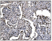 IHC staining of FFPE human lung cancer tissue with FosB antibody. HIER: boil tissue sections in pH8 EDTA for 20 min and allow to cool before testing.