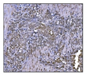 IHC staining of FFPE human gastric cancer tissue with FTO antibody. HIER: boil tissue sections in pH8 EDTA for 20 min and allow to cool before testing.