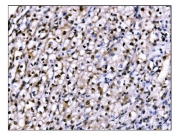 IHC staining of FFPE human renal clear cell carcinoma tissue with FTO antibody. HIER: boil tissue sections in pH8 EDTA for 20 min and allow to cool before testing.