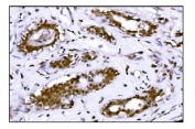 IHC staining of FFPE human breast cancer tissue with FTO antibody. HIER: boil tissue sections in pH8 EDTA for 20 min and allow to cool before testing.