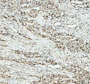IHC staining of FFPE human lung cancer tissue with Histone acetyltransferase 1 antibody, HRP-secondary and DAB substrate. HIER: boil tissue sections in pH8 EDTA for 20 min and allow to cool before testing.