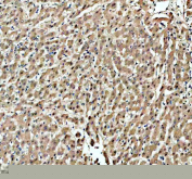 IHC staining of FFPE human liver cancer tissue with Histone acetyltransferase 1 antibody, HRP-secondary and DAB substrate. HIER: boil tissue sections in pH8 EDTA for 20 min and allow to cool before testing.