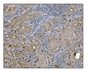 IHC staining of FFPE human gallbladder adenocarcinoma tissue with Holocytochrome c-type synthase antibody. HIER: boil tissue sections in pH8 EDTA for 20 min and allow to cool before testing.