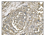 IHC staining of FFPE human pancreatic cancer tissue with Holocytochrome c-type synthase antibody. HIER: boil tissue sections in pH8 EDTA for 20 min and allow to cool before testing.