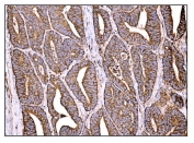 IHC staining of FFPE human rectal cancer tissue with Holocytochrome c-type synthase antibody. HIER: boil tissue sections in pH8 EDTA for 20 min and allow to cool before testing.