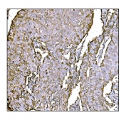 IHC staining of FFPE human breast cancer tissue with Holocytochrome c-type synthase antibody. HIER: boil tissue sections in pH8 EDTA for 20 min and allow to cool before testing.