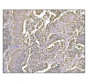 IHC staining of FFPE human lung cancer tissue with Holocytochrome c-type synthase antibody. HIER: boil tissue sections in pH8 EDTA for 20 min and allow to cool before testing.