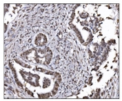 IHC staining of FFPE human cervical cancer tissue with HDAC2 antibody. HIER: boil tissue sections in pH8 EDTA for 20 min and allow to cool before testing.