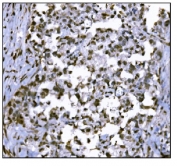 IHC staining of FFPE human gastric cancer tissue with HDAC2 antibody. HIER: boil tissue sections in pH8 EDTA for 20 min and allow to cool before testing.