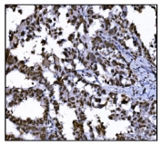 IHC staining of FFPE human ovarian cancer tissue with HDAC2 antibody. HIER: boil tissue sections in pH8 EDTA for 20 min and allow to cool before testing.