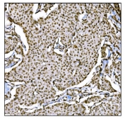 IHC staining of FFPE human breast cancer tissue with HDAC2 antibody. HIER: boil tissue sections in pH8 EDTA for 20 min and allow to cool before testing.