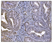 IHC staining of FFPE human endometrial cancer tissue with HDAC2 antibody. HIER: boil tissue sections in pH8 EDTA for 20 min and allow to cool before testing.