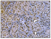 IHC staining of FFPE human gallbladder adenocarcinoma tissue with HDAC2 antibody. HIER: boil tissue sections in pH8 EDTA for 20 min and allow to cool before testing.
