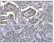 IHC staining of FFPE human lung cancer tissue with HDAC2 antibody. HIER: boil tissue sections in pH8 EDTA for 20 min and allow to cool before testing.