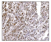 IHC staining of FFPE human liver cancer tissue with LIR-1 antibody. HIER: boil tissue sections in pH8 EDTA for 20 min and allow to cool before testing.