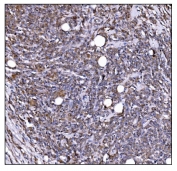 IHC staining of FFPE human lymphoma tissue with LIR-1 antibody. HIER: boil tissue sections in pH8 EDTA for 20 min and allow to cool before testing.