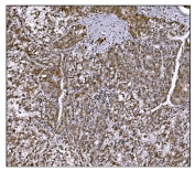 IHC staining of FFPE human liver cancer tissue with LRP1B antibody. HIER: boil tissue sections in pH8 EDTA for 20 min and allow to cool before testing.