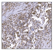 IHC staining of FFPE human pancreatic cancer tissue with LRP1B antibody. HIER: boil tissue sections in pH8 EDTA for 20 min and allow to cool before testing.