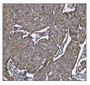 IHC staining of FFPE human breast cancer tissue with LRP1B antibody. HIER: boil tissue sections in pH8 EDTA for 20 min and allow to cool before testing.