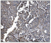 IHC staining of FFPE human lung cancer tissue with LRP1B antibody. HIER: boil tissue sections in pH8 EDTA for 20 min and allow to cool before testing.