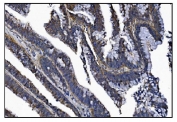 IHC staining of FFPE human rectal cancer tissue with KCNQ2 antibody. HIER: boil tissue sections in pH8 EDTA for 20 min and allow to cool before testing.