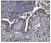 IHC staining of FFPE human lung cancer tissue with KCNQ2 antibody. HIER: boil tissue sections in pH8 EDTA for 20 min and allow to cool before testing.