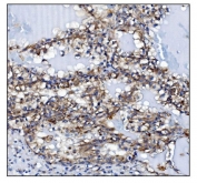 IHC staining of FFPE human renal clear cell carcinoma tissue with KCNQ2 antibody. HIER: boil tissue sections in pH8 EDTA for 20 min and allow to cool before testing.