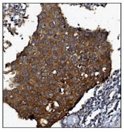 IHC staining of FFPE human breast cancer tissue with KCNQ2 antibody. HIER: boil tissue sections in pH8 EDTA for 20 min and allow to cool before testing.