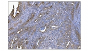 IHC staining of FFPE human gallbladder adenocarcinoma tissue with MerTK antibody. HIER: boil tissue sections in pH8 EDTA for 20 min and allow to cool before testing.