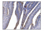 IHC staining of FFPE human rectal cancer tissue with MerTK antibody. HIER: boil tissue sections in pH8 EDTA for 20 min and allow to cool before testing.