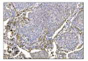IHC staining of FFPE human lung cancer tissue with MerTK antibody. HIER: boil tissue sections in pH8 EDTA for 20 min and allow to cool before testing.