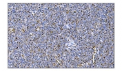 IHC staining of FFPE human lymphoma tissue with MerTK antibody. HIER: boil tissue sections in pH8 EDTA for 20 min and allow to cool before testing.