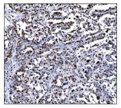 IHC staining of FFPE human ovarian cancer tissue with Ki67 antibody. HIER: boil tissue sections in pH8 EDTA for 20 min and allow to cool before testing.