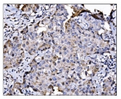IHC staining of FFPE human breast cancer tissue with NDE1 antibody. HIER: boil tissue sections in pH8 EDTA for 20 min and allow to cool before testing.