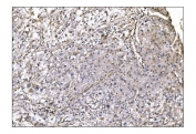 IHC staining of FFPE human liver cancer tissue with Nudel antibody. HIER: boil tissue sections in pH8 EDTA for 20 min and allow to cool before testing.