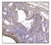 IHC staining of FFPE human endometrial cancer tissue with Nudel antibody. HIER: boil tissue sections in pH8 EDTA for 20 min and allow to cool before testing.