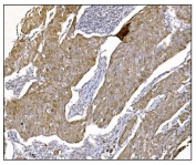 IHC staining of FFPE human breast cancer tissue with Nudel antibody. HIER: boil tissue sections in pH8 EDTA for 20 min and allow to cool before testing.