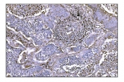 IHC staining of FFPE human lung cancer tissue with Nudel antibody. HIER: boil tissue sections in pH8 EDTA for 20 min and allow to cool before testing.