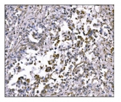 IHC staining of FFPE human gastric cancer tissue with Nudel antibody. HIER: boil tissue sections in pH8 EDTA for 20 min and allow to cool before testing.