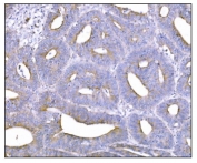IHC staining of FFPE human rectal cancer tissue with Nudel antibody. HIER: boil tissue sections in pH8 EDTA for 20 min and allow to cool before testing.
