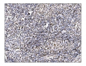 IHC staining of FFPE human testicular cancer tissue with Ornithine Aminotransferase antibody. HIER: boil tissue sections in pH8 EDTA for 20 min and allow to cool before testing.