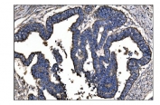 IHC staining of FFPE human rectal cancer tissue with Ornithine Aminotransferase antibody. HIER: boil tissue sections in pH8 EDTA for 20 min and allow to cool before testing.