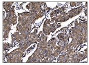 IHC staining of FFPE human breast cancer tissue with POGLUT1 antibody. HIER: boil tissue sections in pH8 EDTA for 20 min and allow to cool before testing.