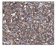 IHC staining of FFPE human lymphoma tissue with POGLUT1 antibody. HIER: boil tissue sections in pH8 EDTA for 20 min and allow to cool before testing.