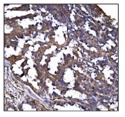 IHC staining of FFPE human ovarian cancer tissue with POGLUT1 antibody. HIER: boil tissue sections in pH8 EDTA for 20 min and allow to cool before testing.