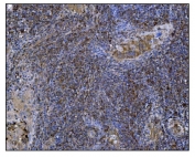 IHC staining of FFPE human gallbladder adenocarcinoma tissue with POGLUT1 antibody. HIER: boil tissue sections in pH8 EDTA for 20 min and allow to cool before testing.