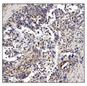 IHC staining of FFPE human gastric cancer tissue with POGLUT1 antibody. HIER: boil tissue sections in pH8 EDTA for 20 min and allow to cool before testing.